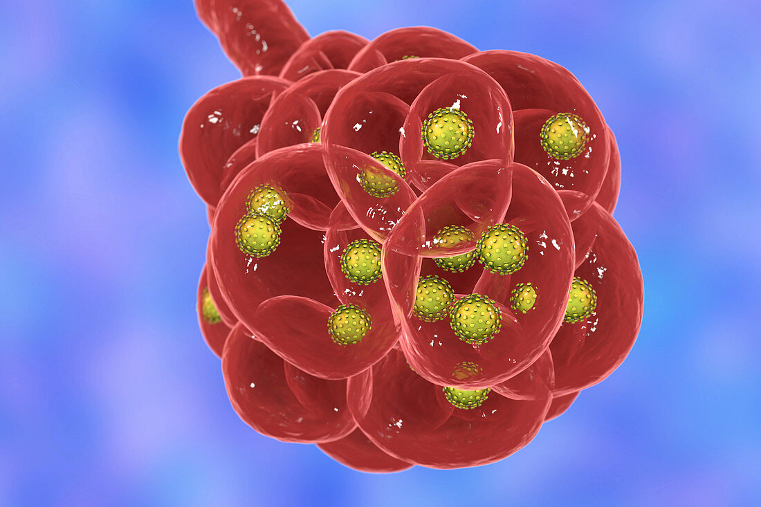 Coronavirus disease of the lungs, conceptual illustration