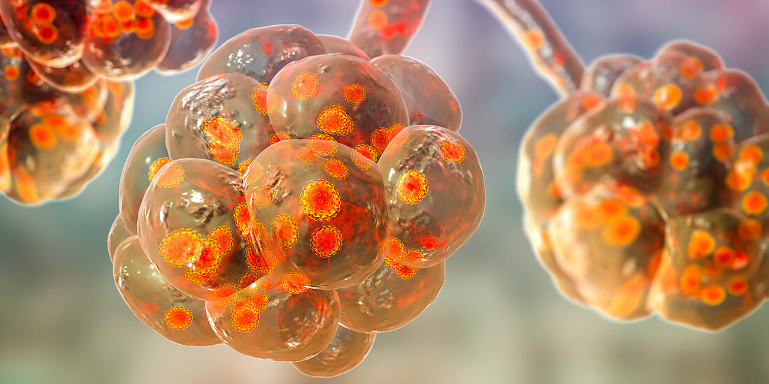 Coronavirus disease of the lungs, conceptual illustration