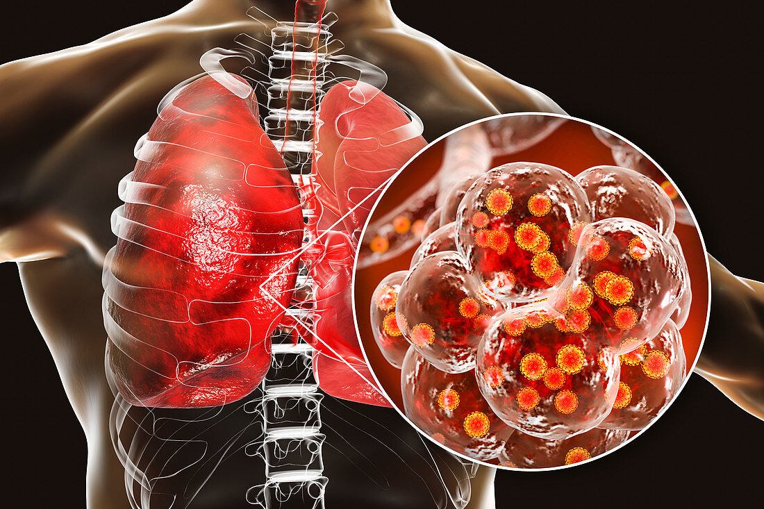 Coronavirus disease of the lungs, conceptual illustration