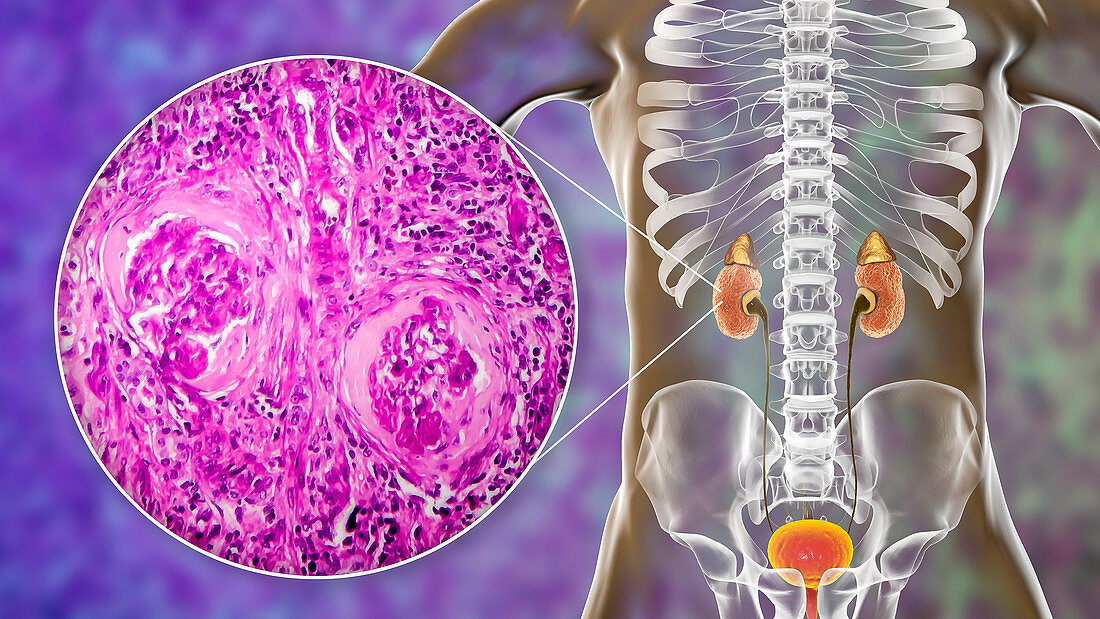 Chronic kidney disease, illustration and light micrograph