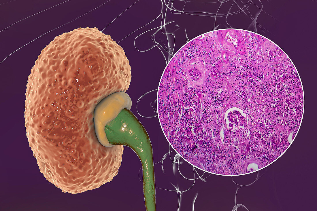 Chronic kidney disease, illustration and light micrograph