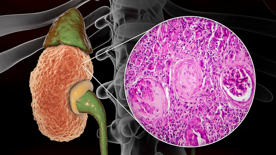 Chronic kidney disease, illustration and light micrograph