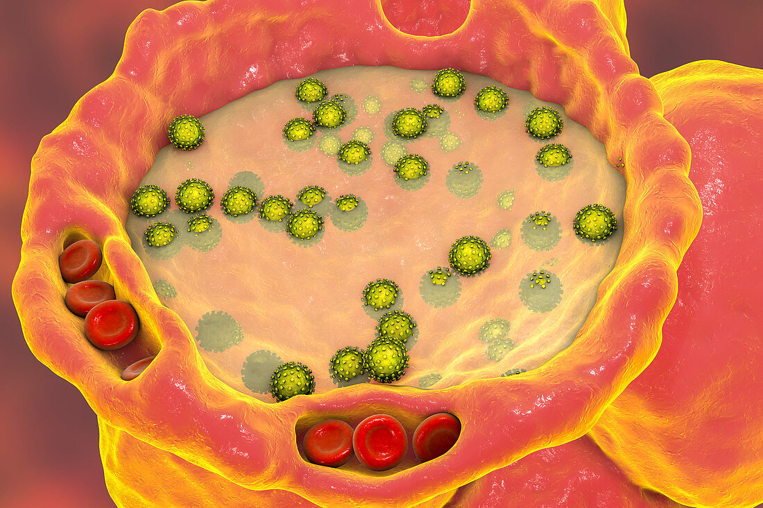 Covid-19 infection, illustration