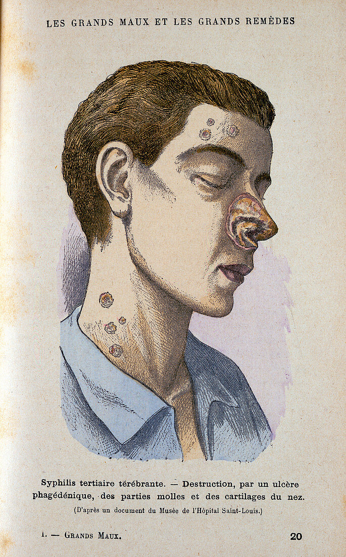 Symptoms of the tertiary phase of syphilis, c19th century