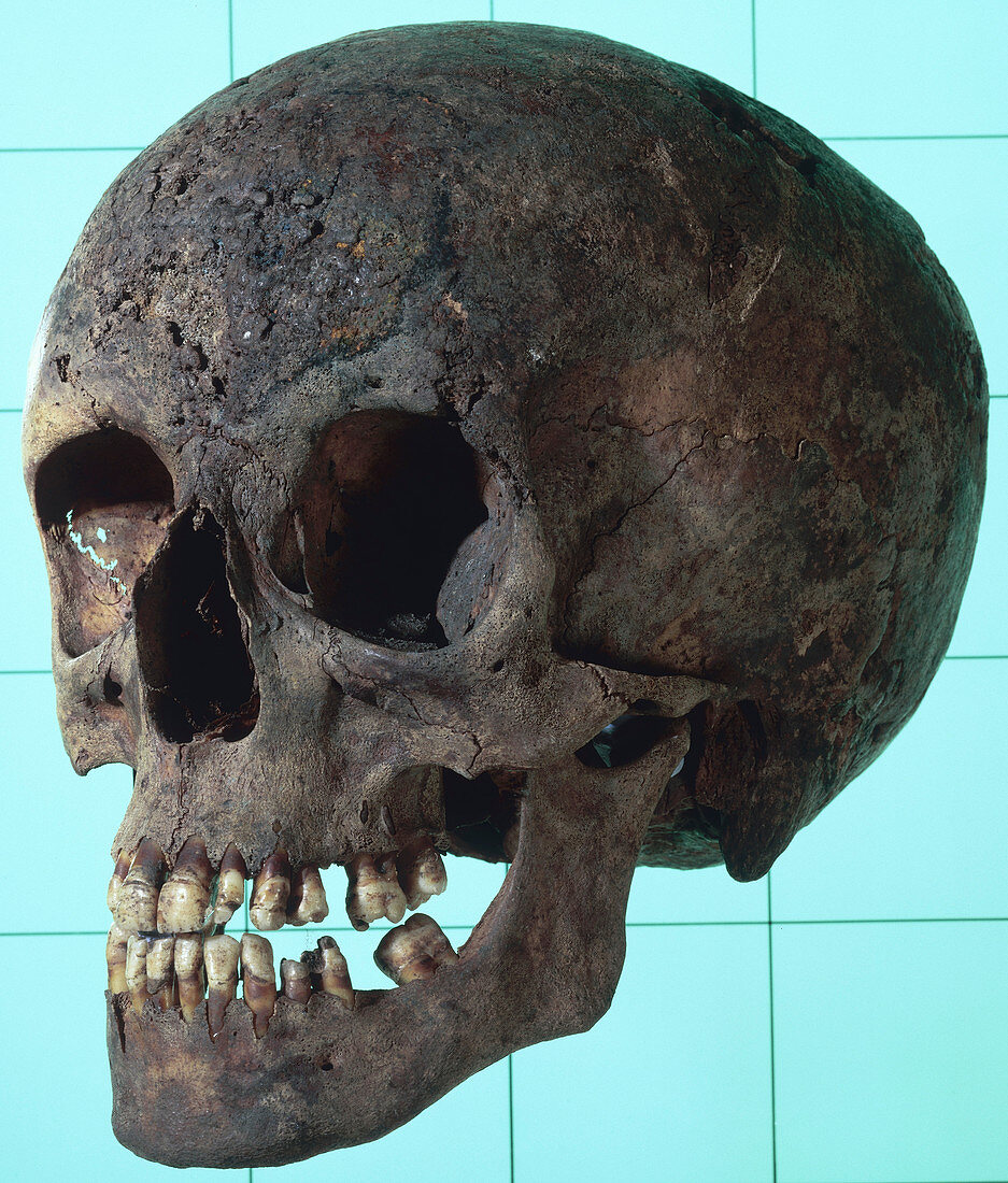 Female syphilitic skull with multiple erosive lesions