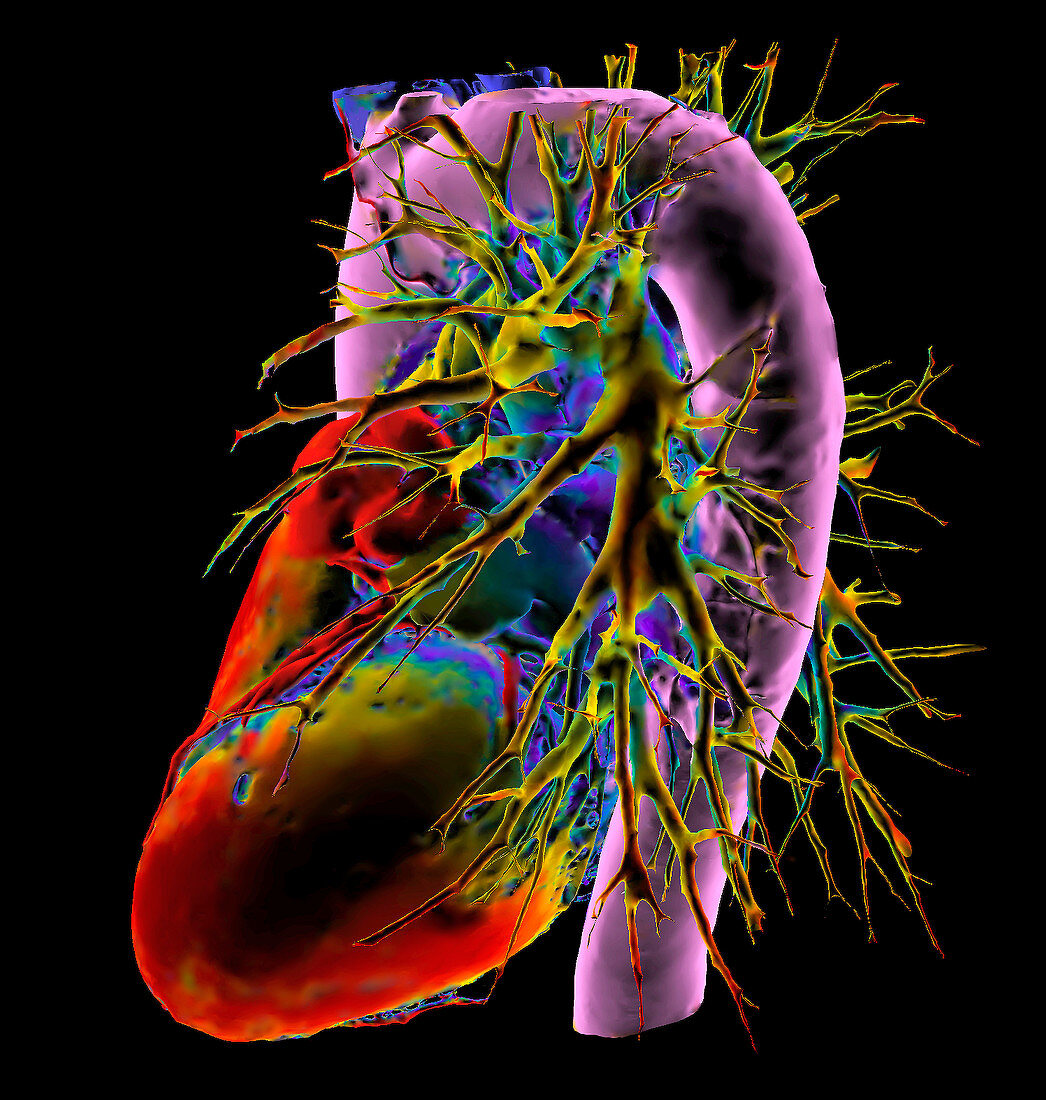 Pulmonary artery aneurysm, 3D CT scan