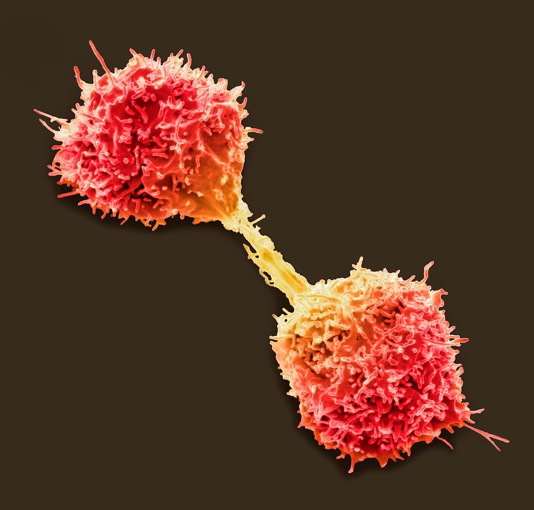 Dividing lymphoma cancer cell, SEM