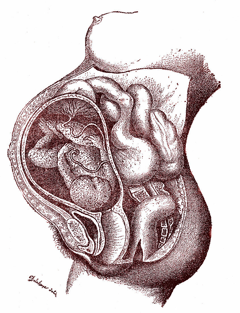 Calcified foetus, 19th century