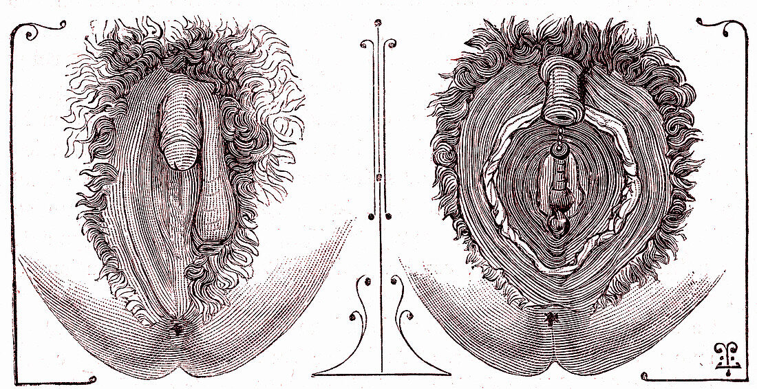 Intersex external sex organs, 19th century