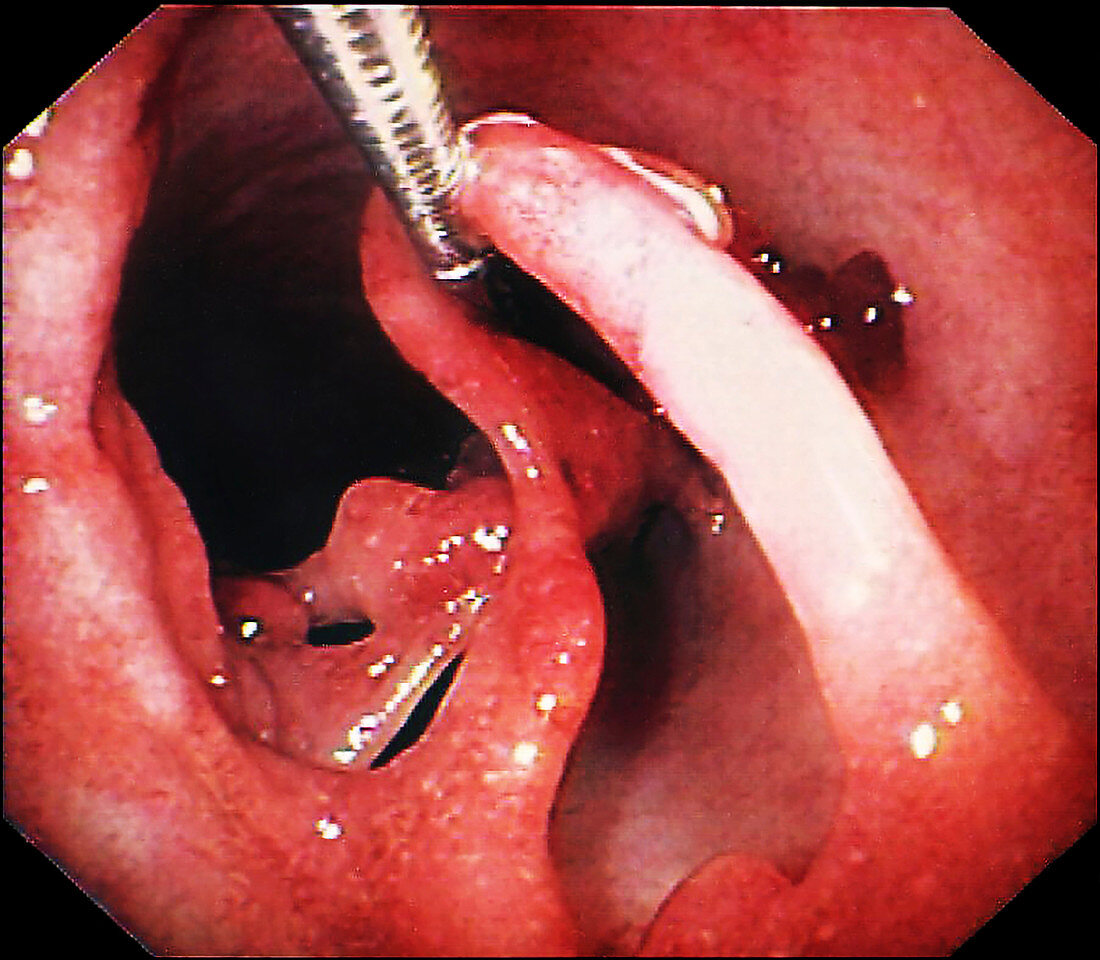 Mucosal bridging in ulcerative colitis, colonoscopy image