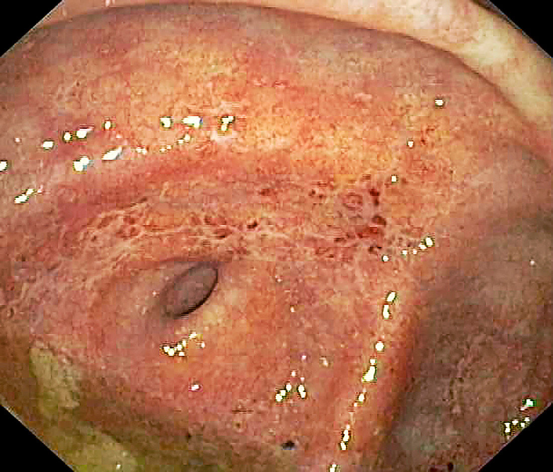 Large intestine in ulcerative colitis, colonoscopy image