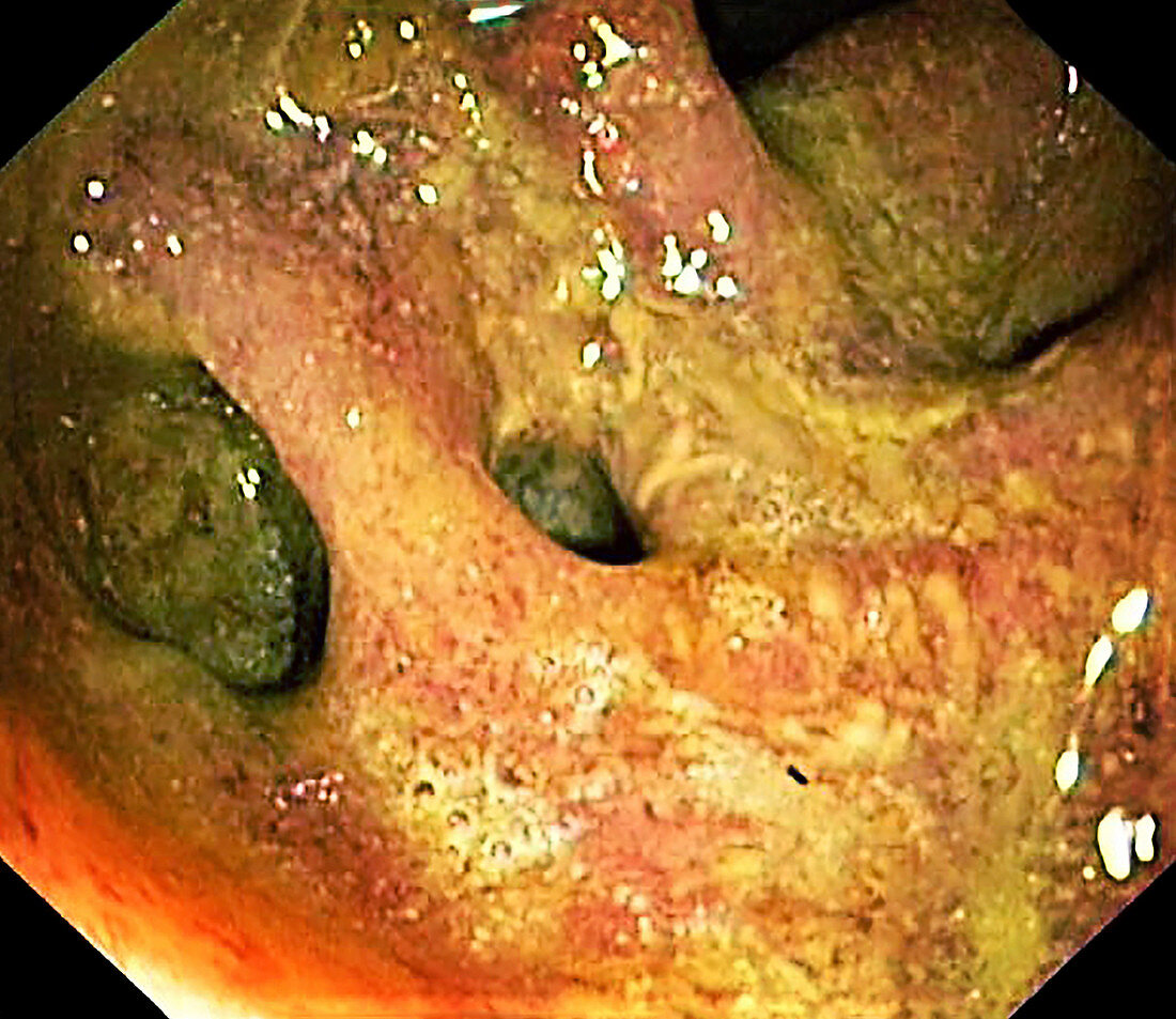 Diverticula in ulcerative colitis, colonoscopy image