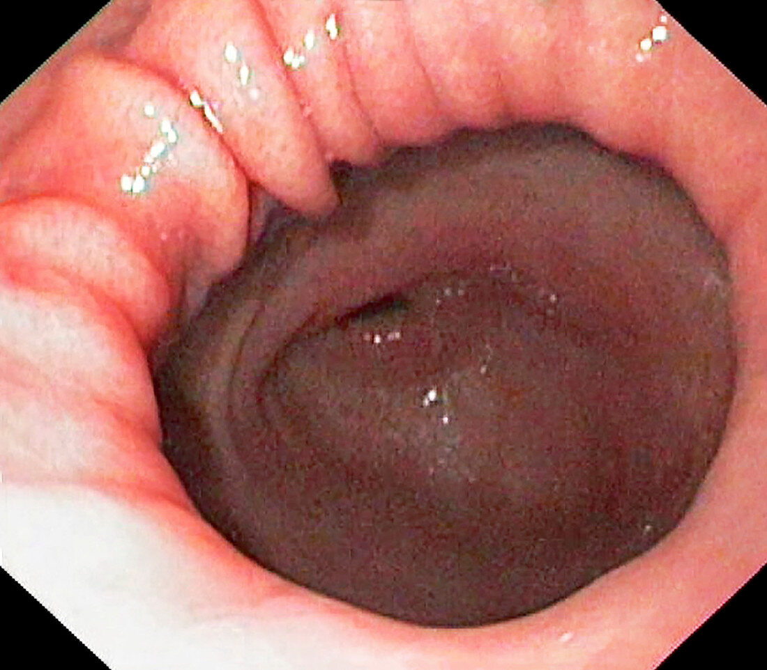 Normal pyloric sphincter, endoscopic image