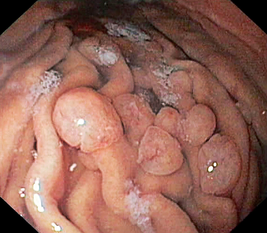 Hyperplastic polyps in the stomach, endoscopic image