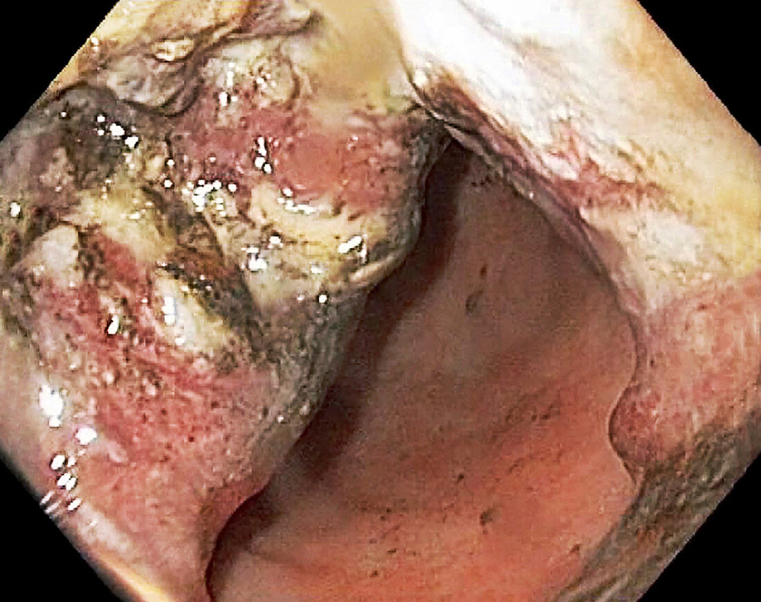 Stomach cancer, colonoscopy image