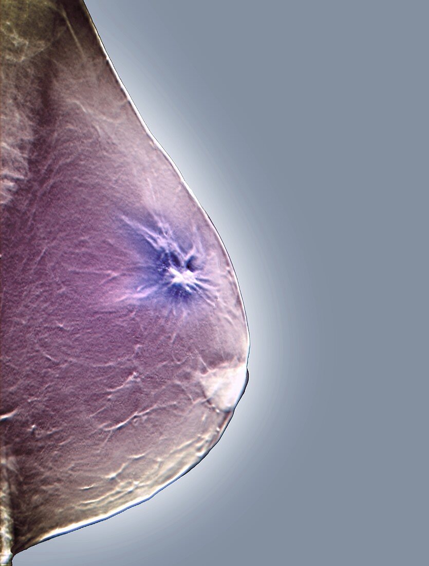 Breast lump, CT scan