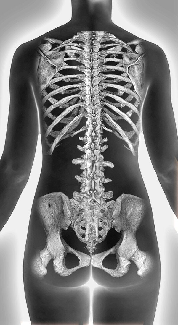 Normal spine, 3d CT scan
