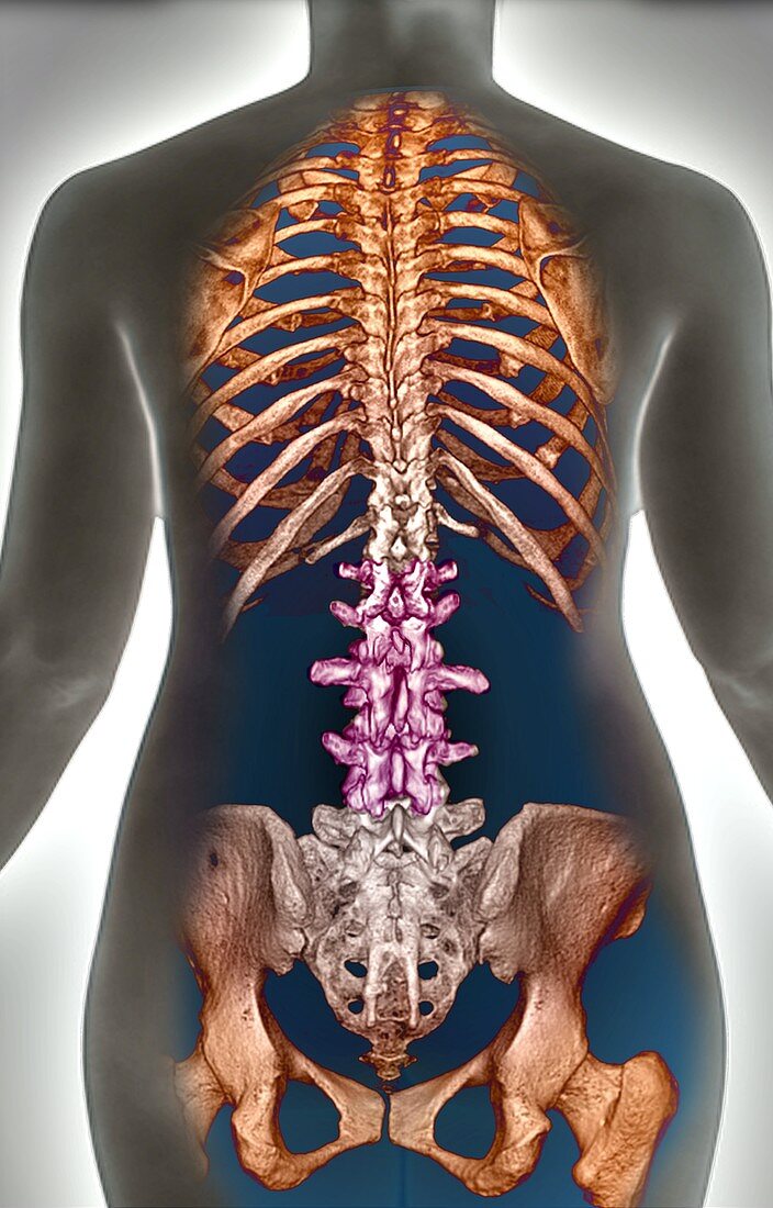 Normal spine, 3d CT scan