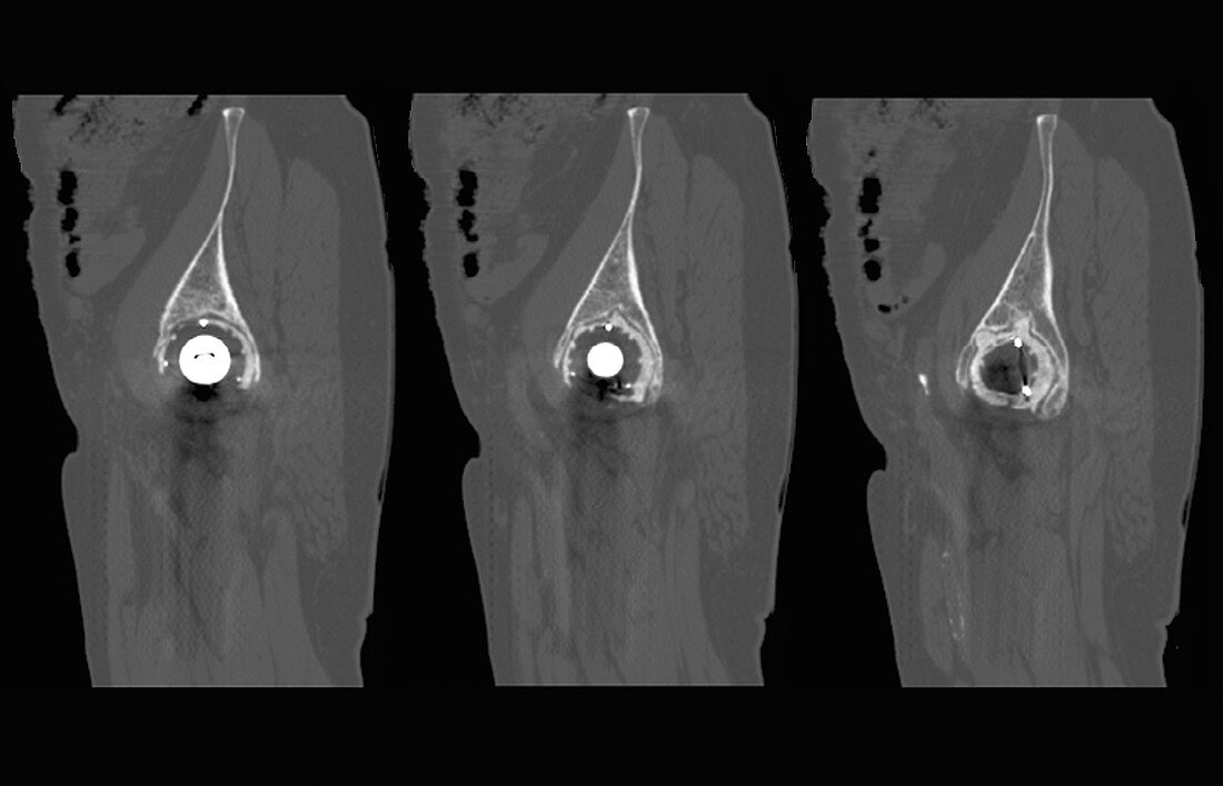 Loosened total hip replacement, CT scans
