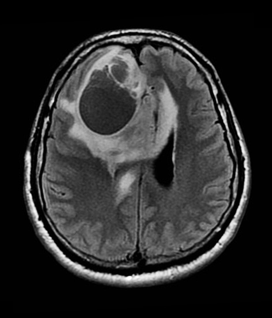 Brain tumour, MRI