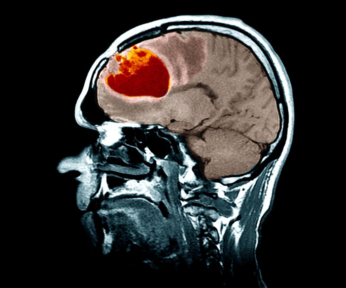 Brain tumour, MRI