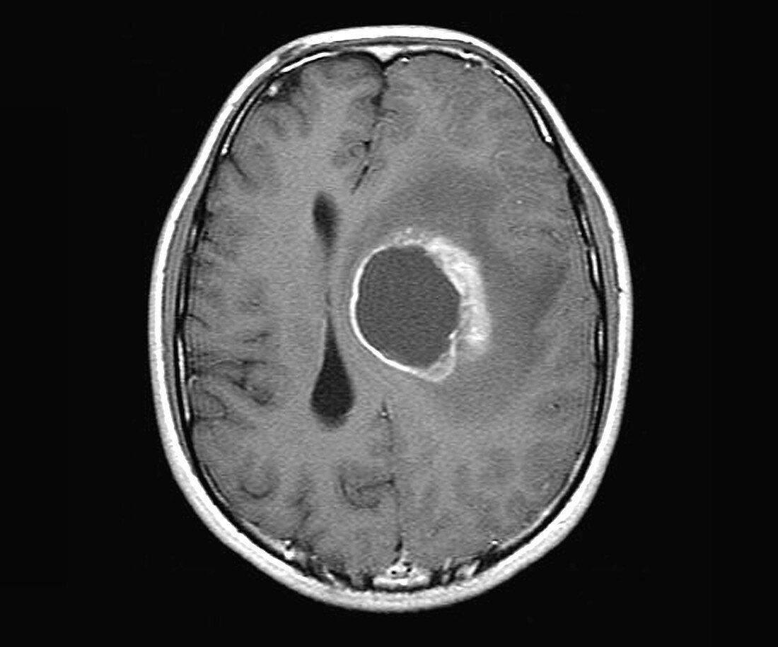 Brain cancer, MRI