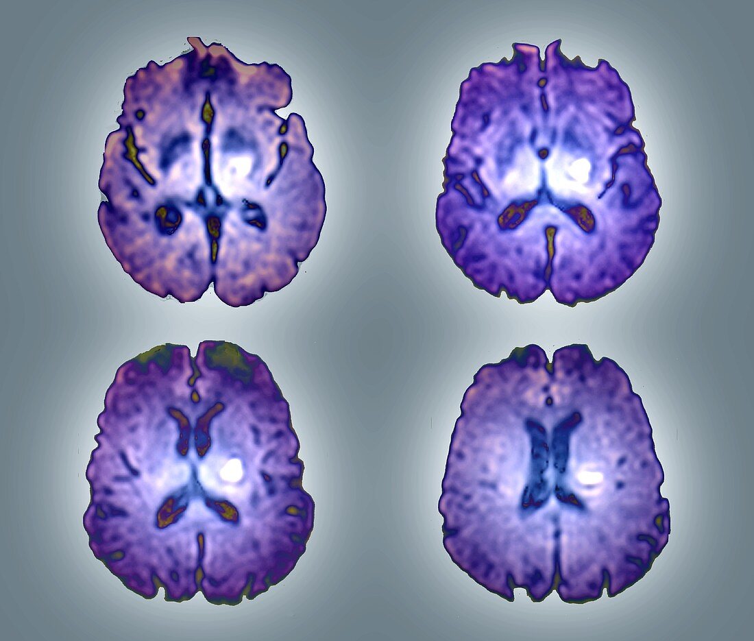 Intracerebral haemorrhage, MRI