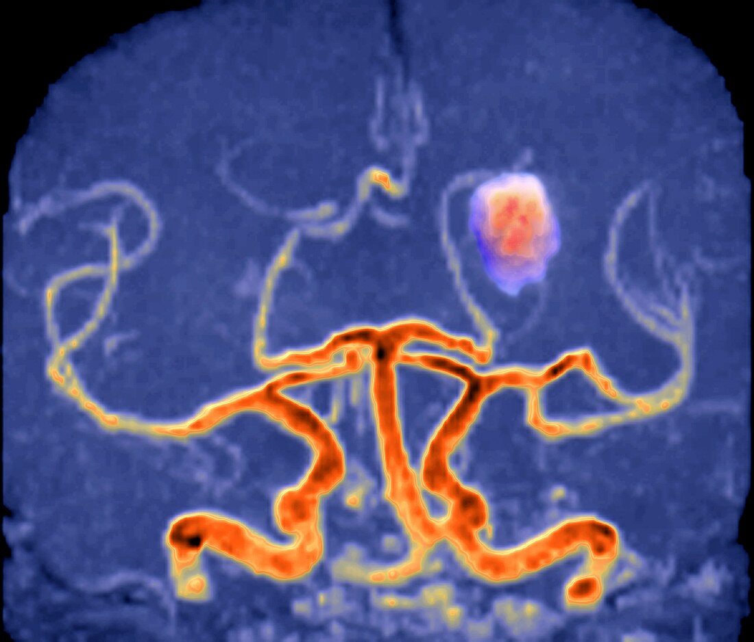 Intracerebral haemorrhage, MRI