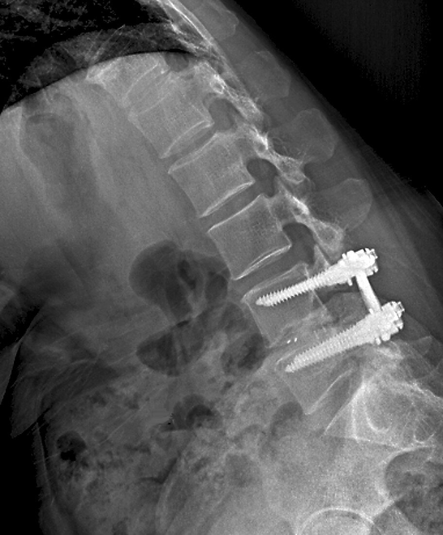 Treatment of spinal disc herniation, X-ray