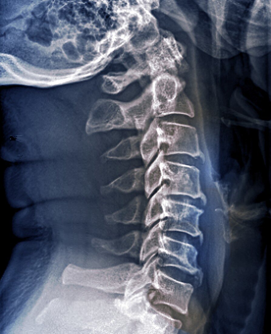 Spinal arthritis, X-ray