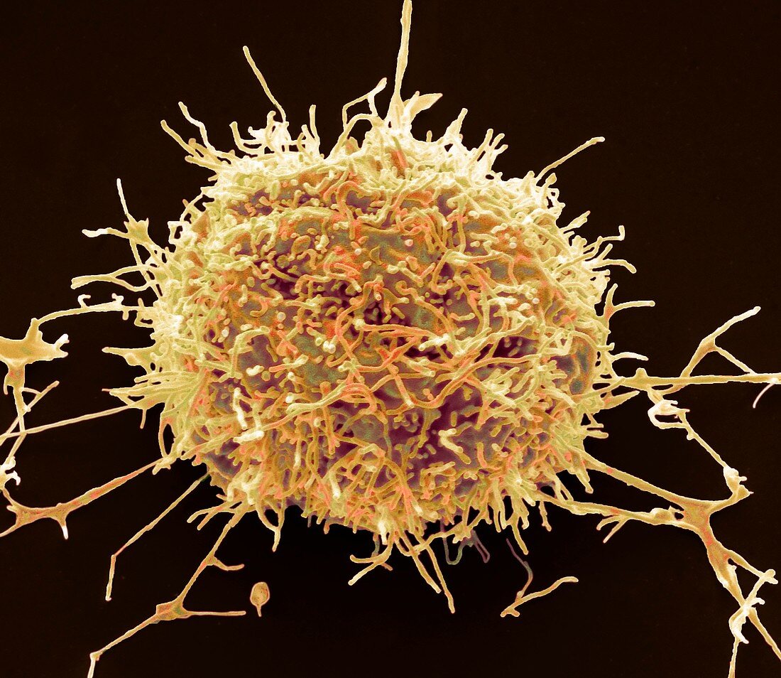 Mesothelioma cancer cell, SEM
