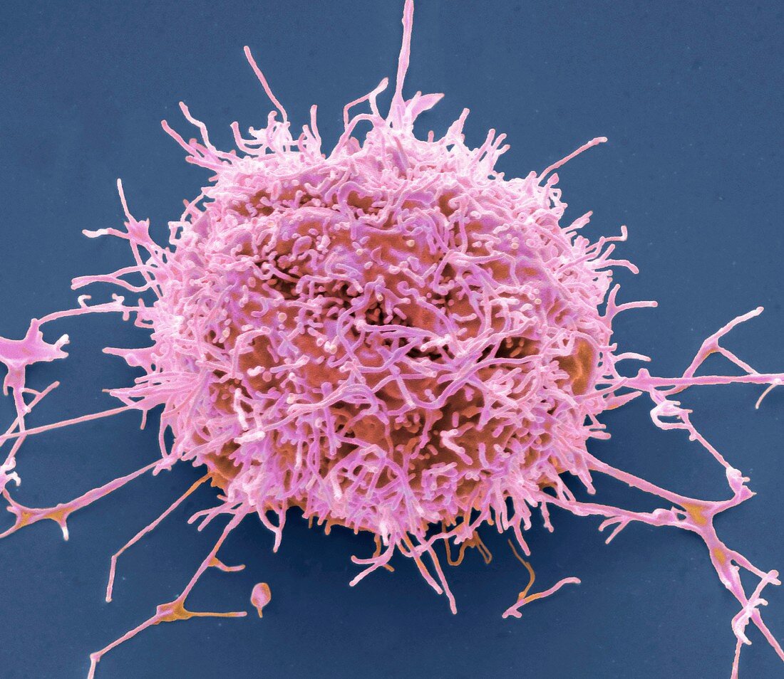 Mesothelioma cancer cell, SEM