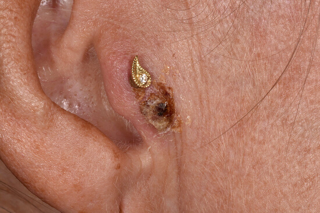 Infected ear piercing