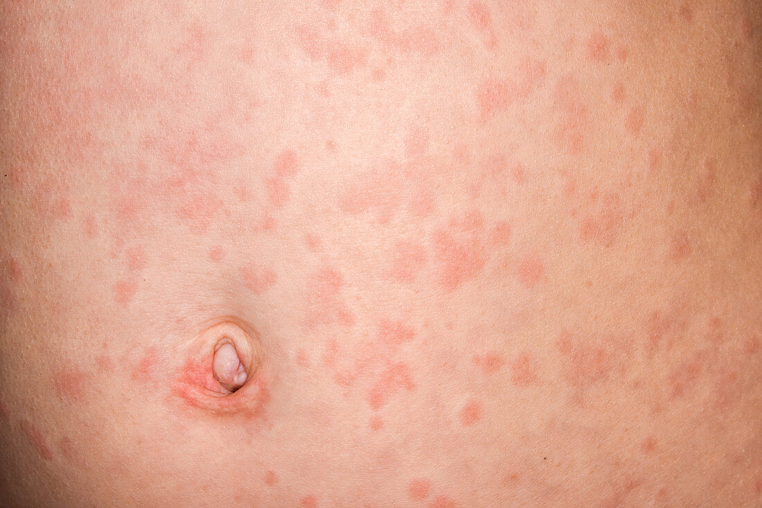 Urticaria rash due to vaccine reaction