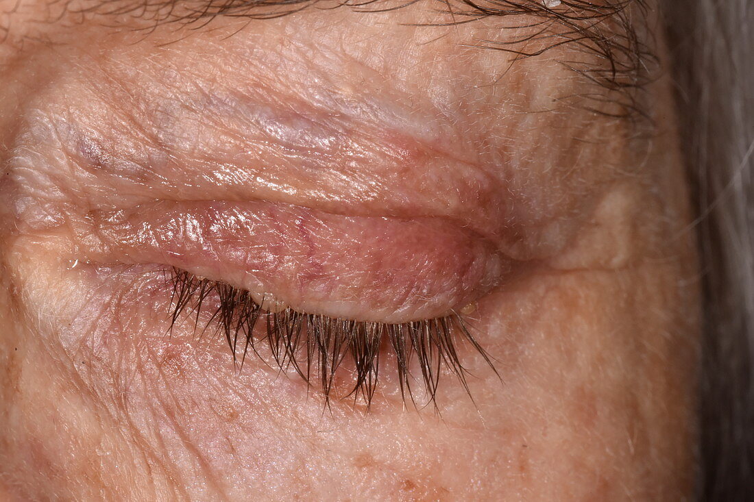 Eczema affecting the eyes