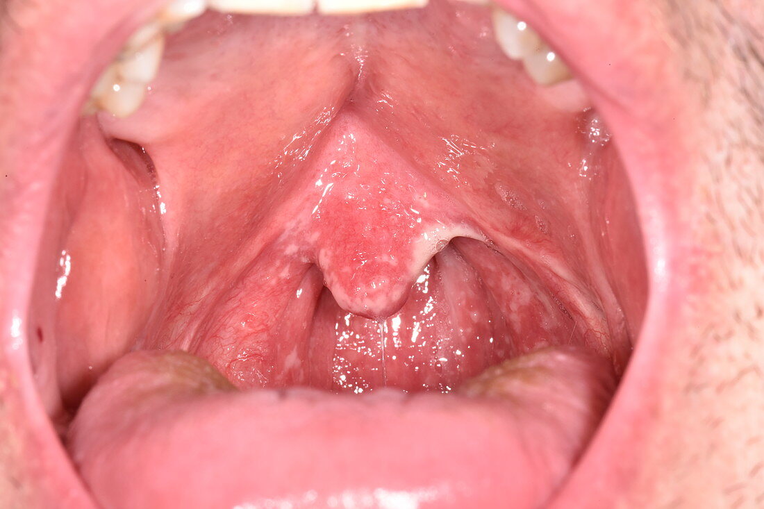 Oral thrush in HIV patient