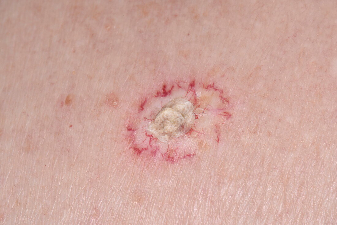 Hyperkeratosis after skin cancer radiotherapy
