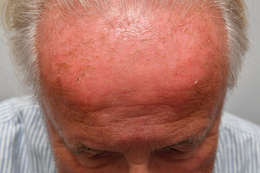 Chemical burn on forehead from drug treatment
