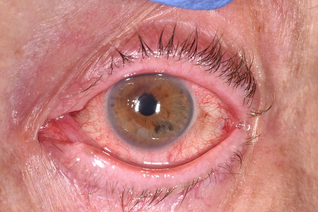 Corneal abrasion