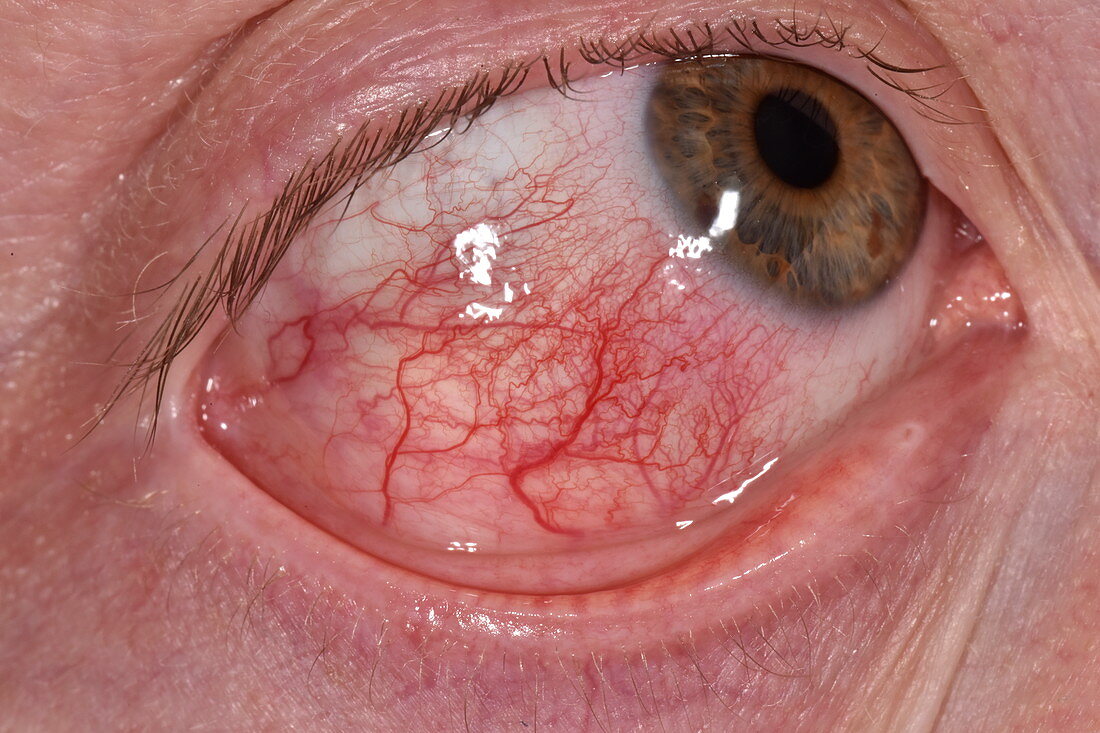 Episcleritis