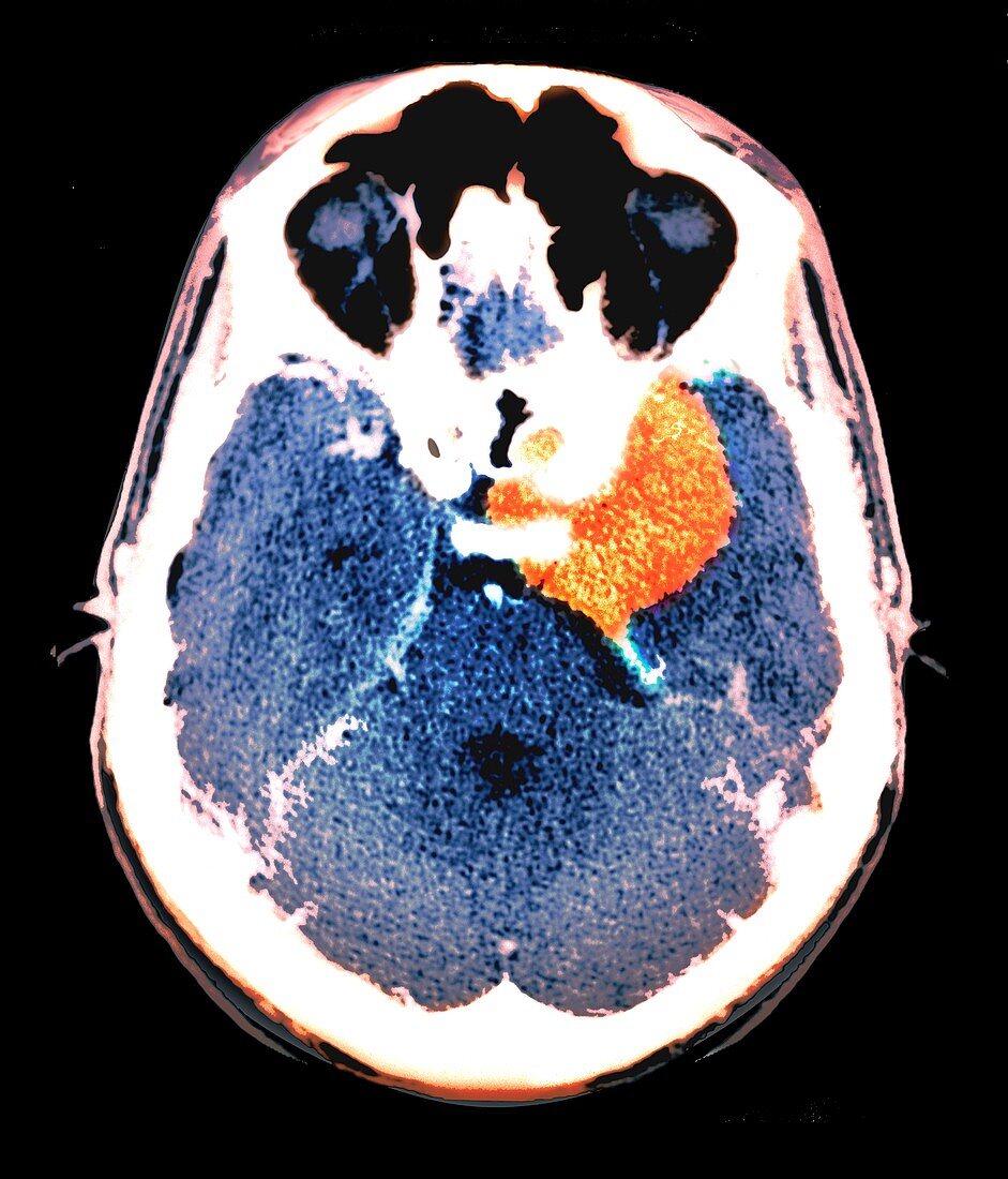 Meningioma brain tumour, CT scan