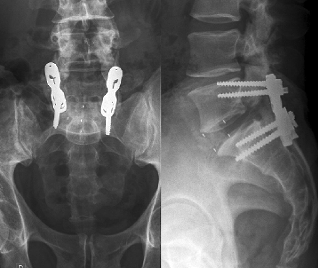 Intervertebral fixing, X-rays