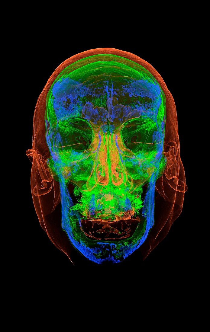 Head and skull, 3D CT scan