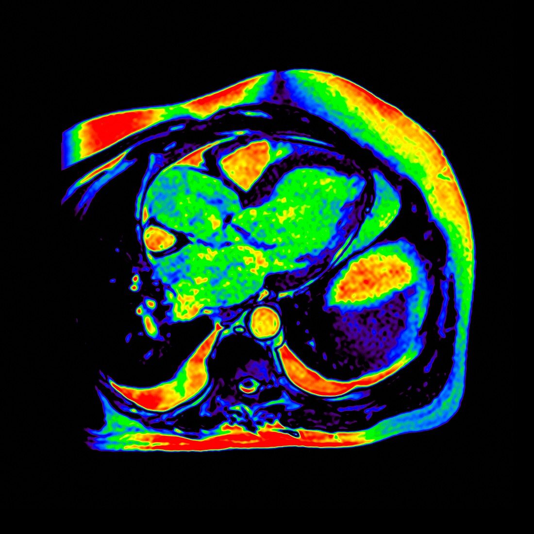 Heart valve insufficiency, MRI scan
