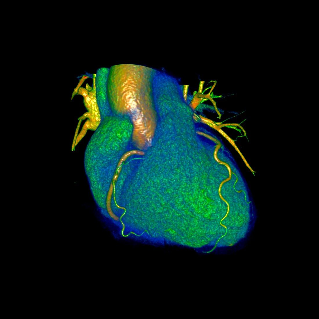 Coronary artery disease, 3D CT scan