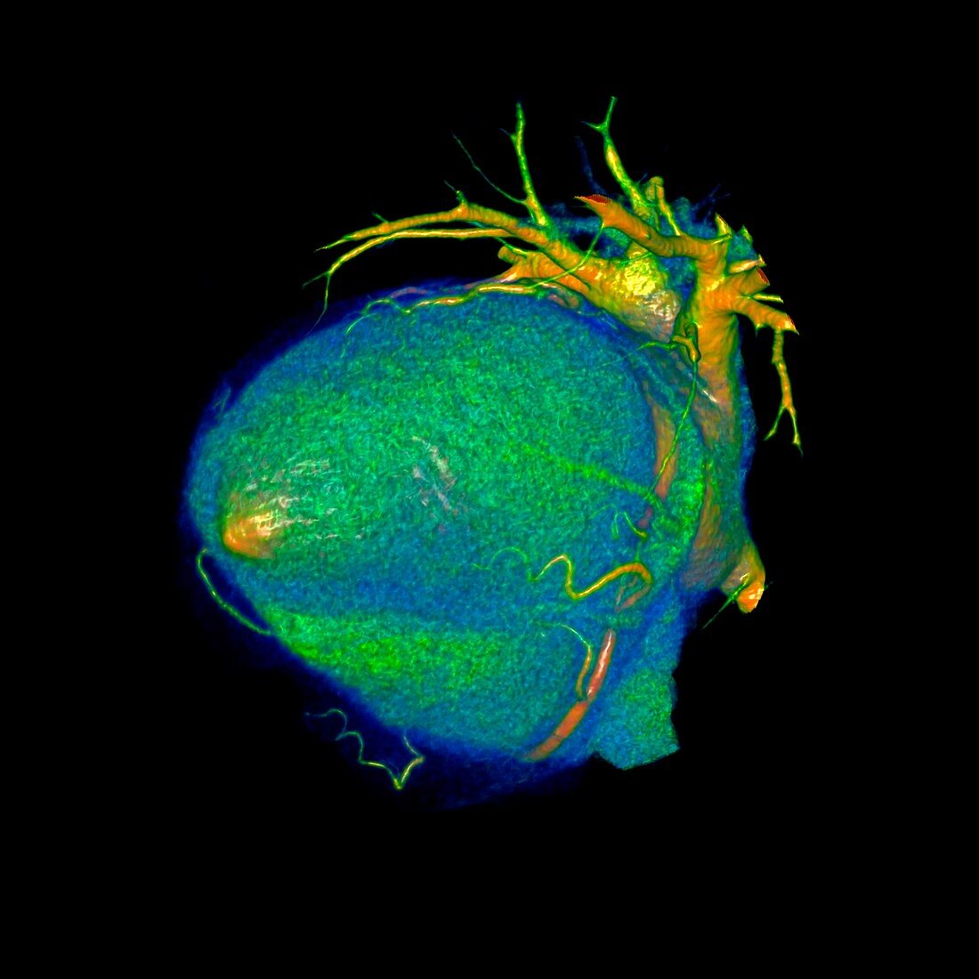 Coronary artery disease, 3D CT scan