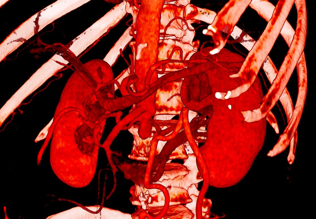 Aortoiliac occlusive disease, 3D CT scan