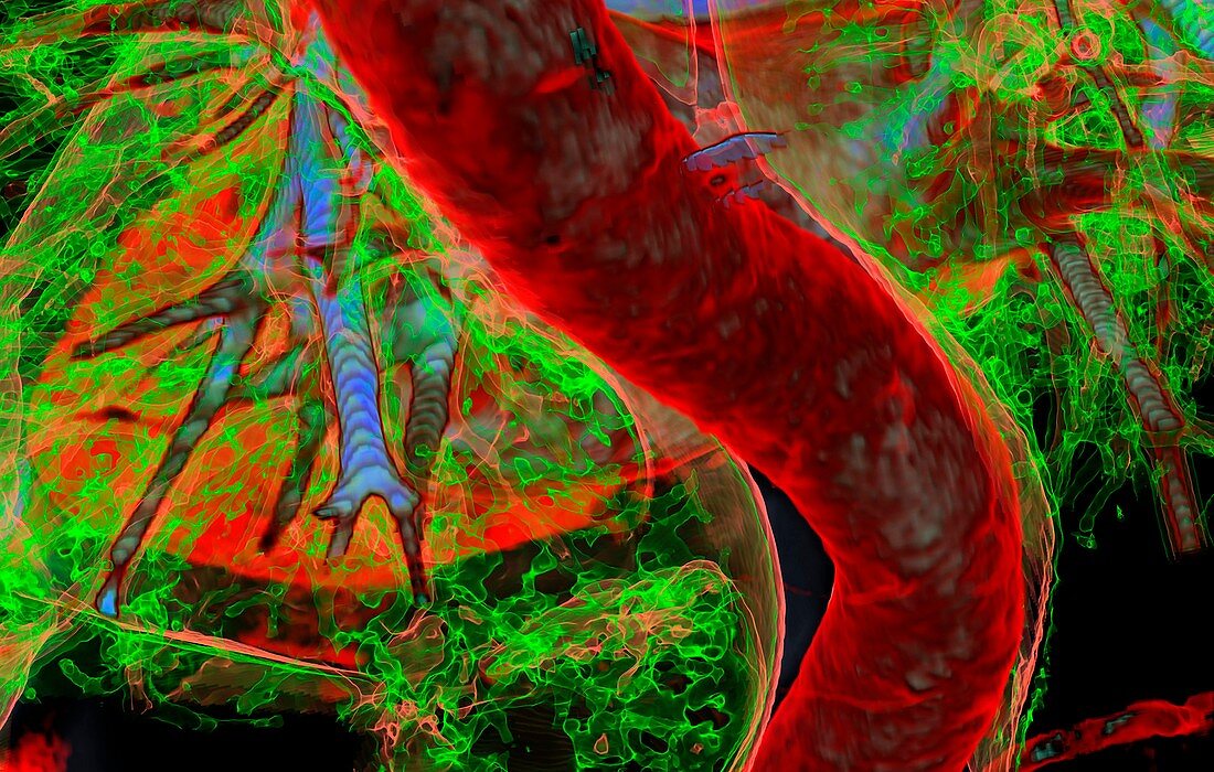 Aorta and lung airways, 3D CT scan