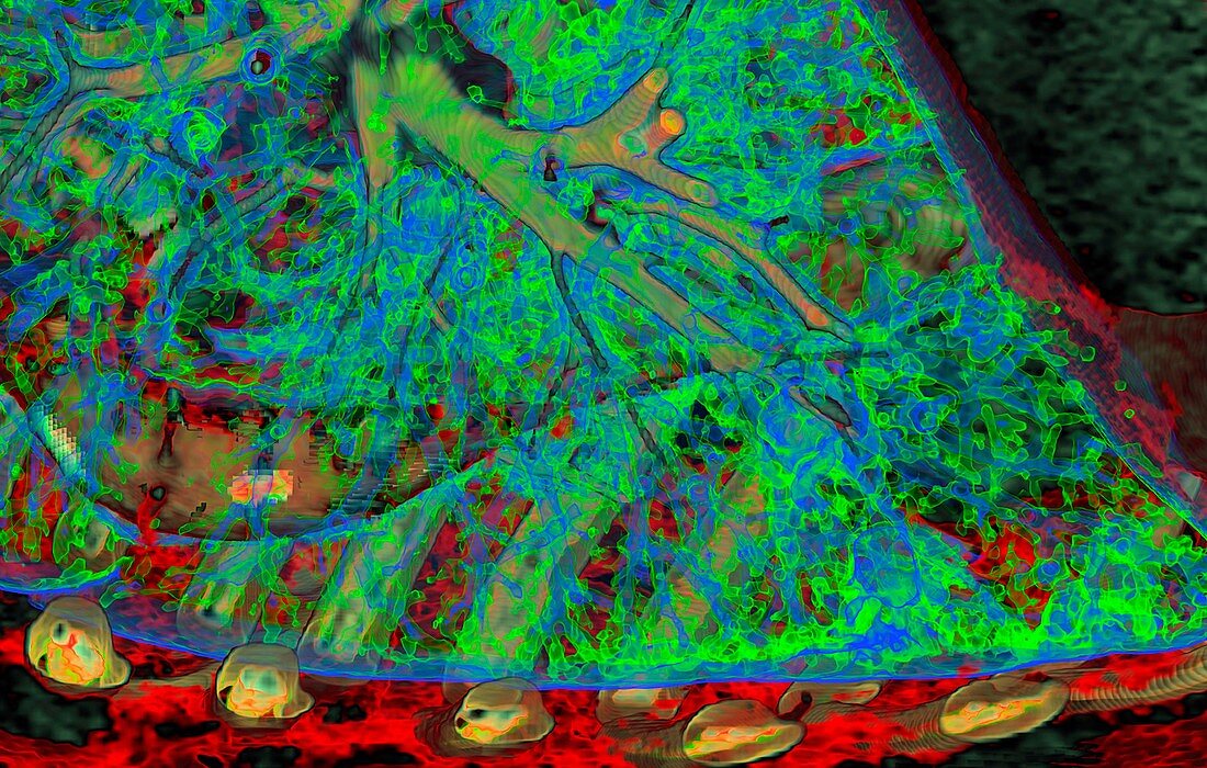 Lung airways, 3D CT scan