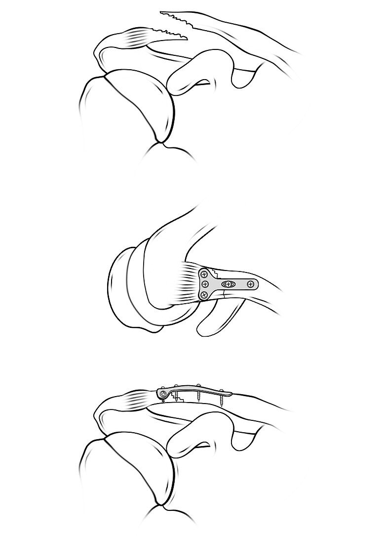 Clavicle fracture repair surgery, illustration